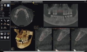 CBCT o TAC dental