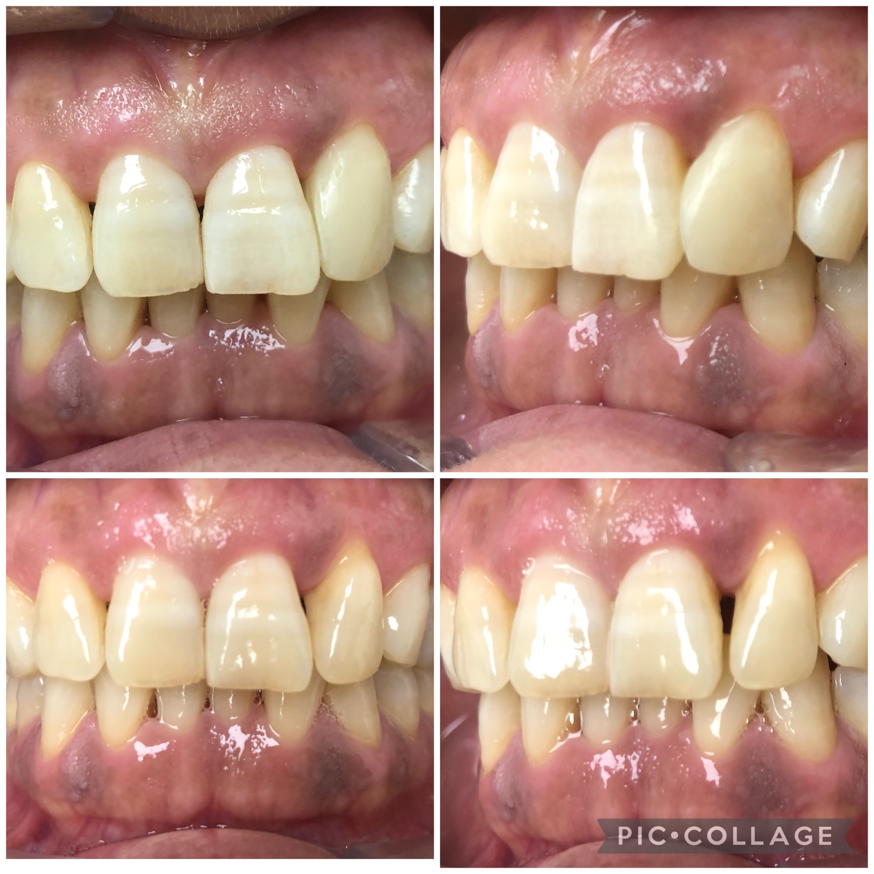 cierre de diastema