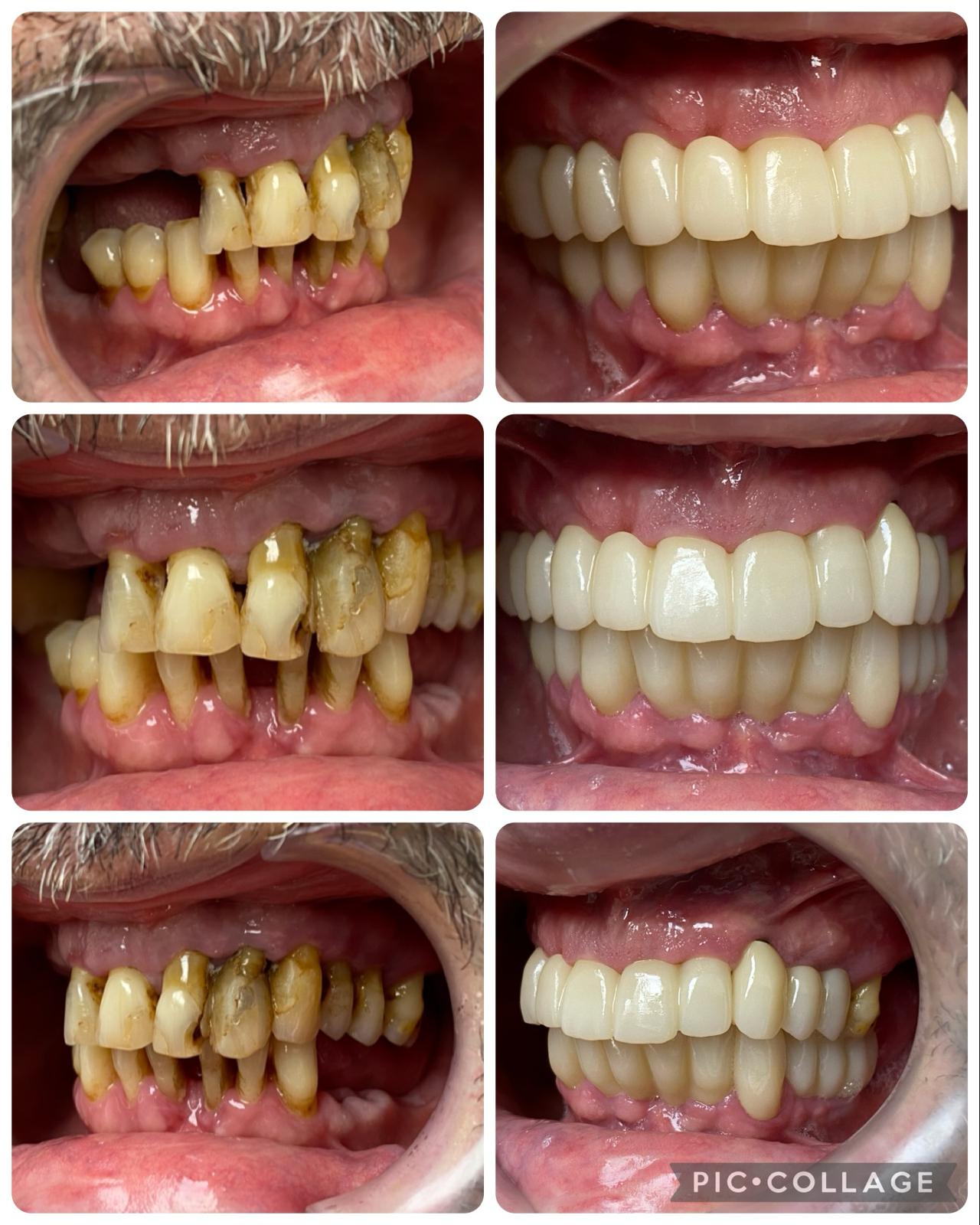 rehabilitacion sobre implantes 2 arcadas